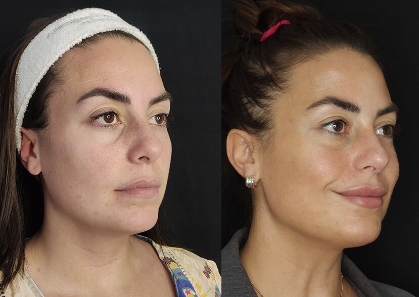 Armonización facial paso a paso