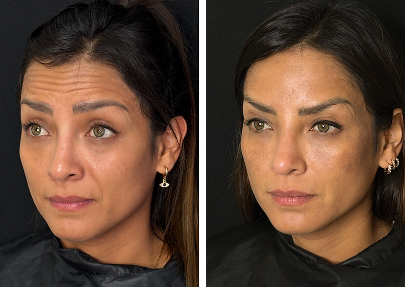 Resultados de armonización facial en paciente